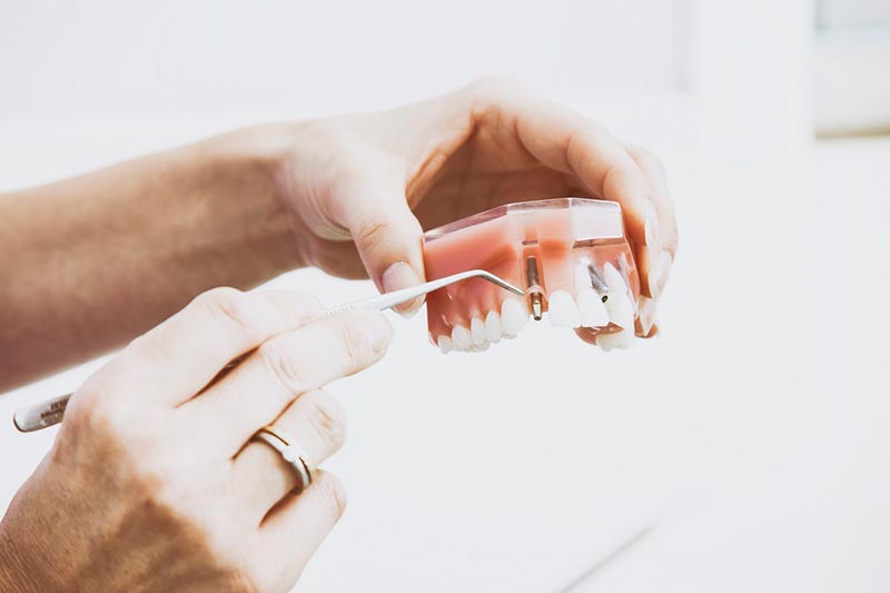 biomateriales-dentales-implante-dental