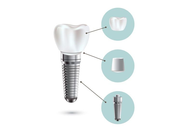 tipos de conexiones en implantes dentales